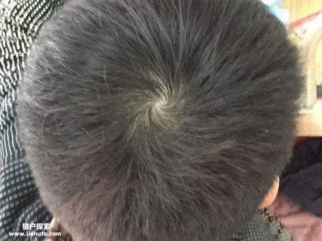 发旋